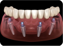 implant3