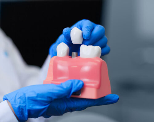Implant Expertise at Dentist Millburn