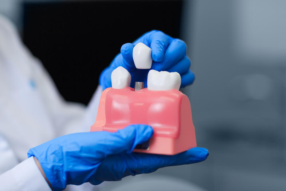Implant Expertise at Dentist Millburn
