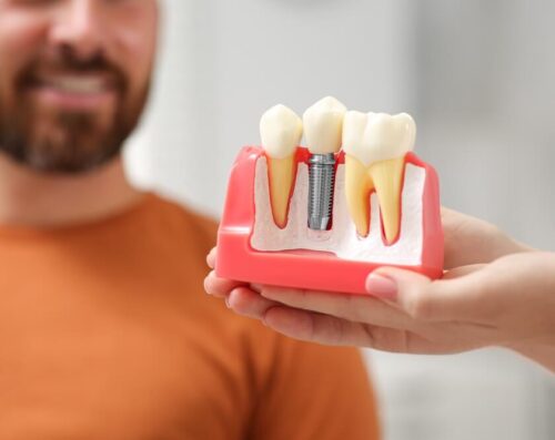 person holding dental implants example