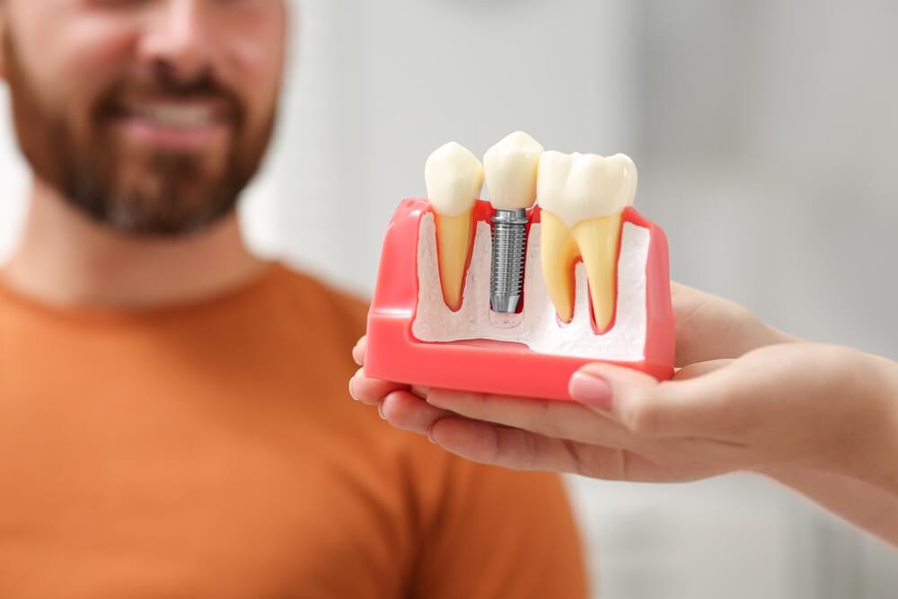 person holding dental implants example