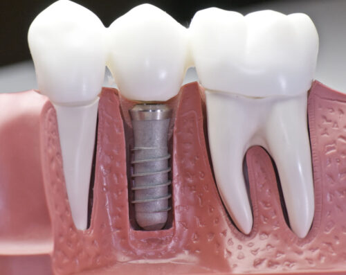 dental-implants-procedure