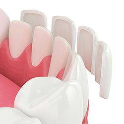 Dental veneers cosmetic dentistry
