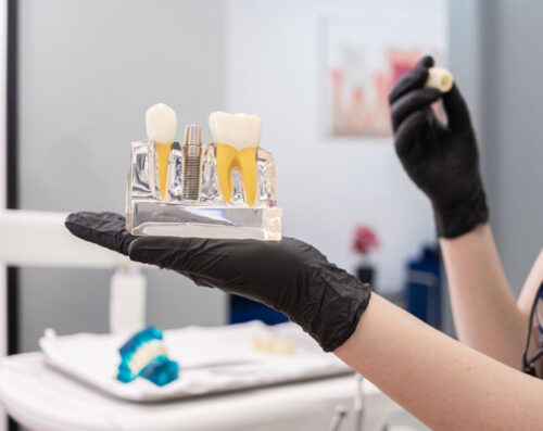 A dental professional in black gloves holds a clear model showing a dental implant with the post and crown.