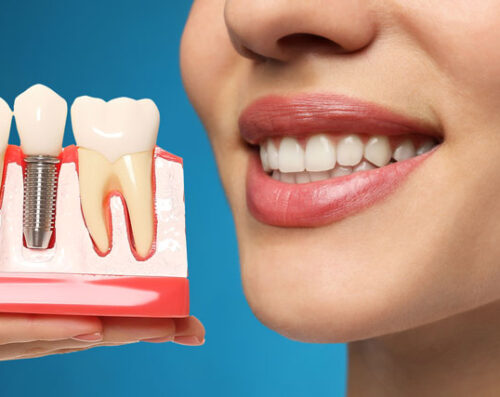 A woman smiles, holding a dental implant model showing the post and crown, emphasizing the natural, restored look and aesthetic benefits.