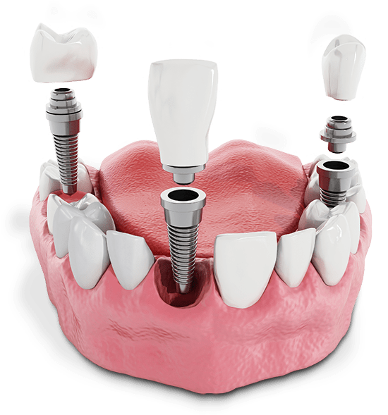 Three Single Dental Implants In A Mouth Graphic