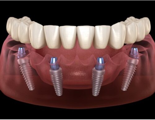Full Mouth Dental Implants