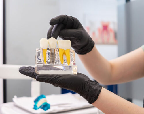 Dental expert holding human teeth model, pointing to the crown of a dental implant, and offering advice on dental implant maintenance and healthy teeth care.