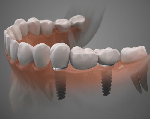 a single dental implant 3d model with grey background