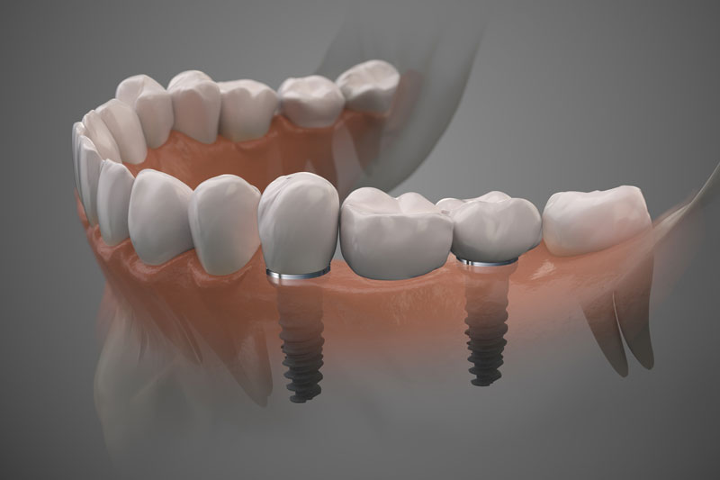 The Intricacies of Tooth Transplants & Why Dental Implants Are the