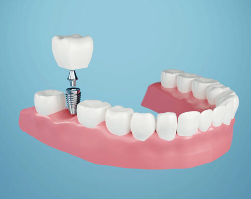 Dental implant, Fixing missing teeth with metal screw, teeth crown treatment 3D rendering