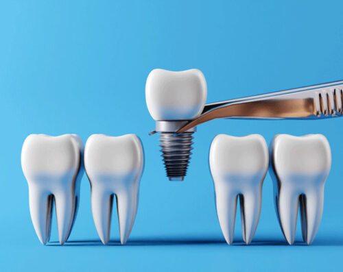 Dental implants and Healthy white teeth, picked up by dental tweezers. Oral health and dental inspection teeth.