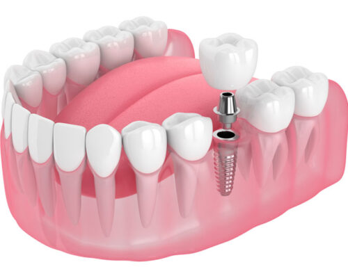 A 3D rendering of a dental implant in a pink gum model, showing a metal screw with an abutment and crown, illustrating the replacement of a single missing tooth.