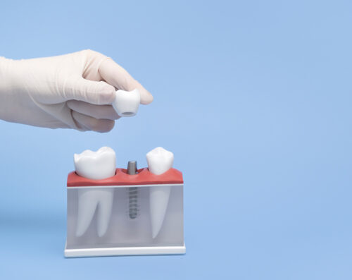 A hand in a white glove holds a model of a tooth implant blue table and background