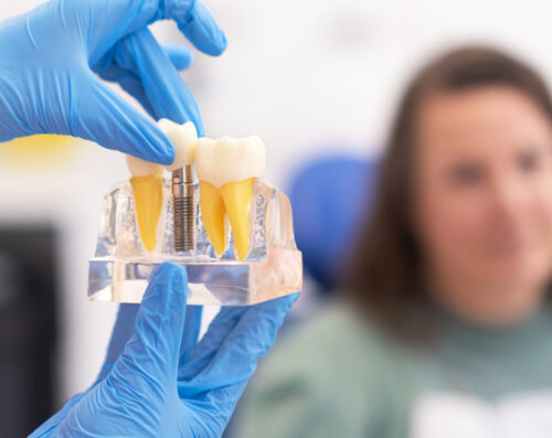 Free consultation dental implants