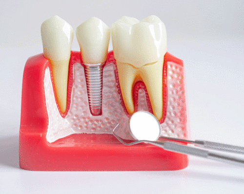 Dental implant, artificial tooth roots into jaw, root canal of dental treatment, gum disease, teeth model for dentist studying about dentistry.