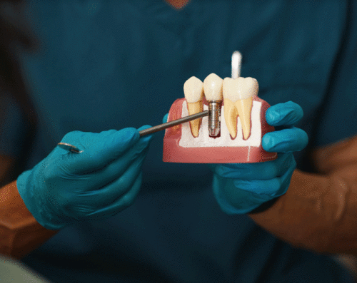 Dentist holding dental implant, artificial tooth roots into jaw, root canal of dental treatment, gum disease, teeth model for dentist.