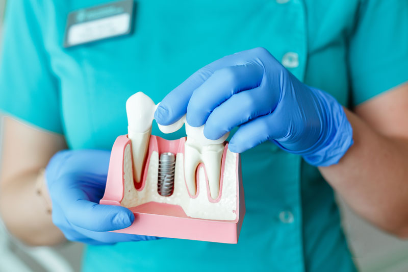 Unpacking Dental Implants: What’s an Implant, How It Works, and Its ...