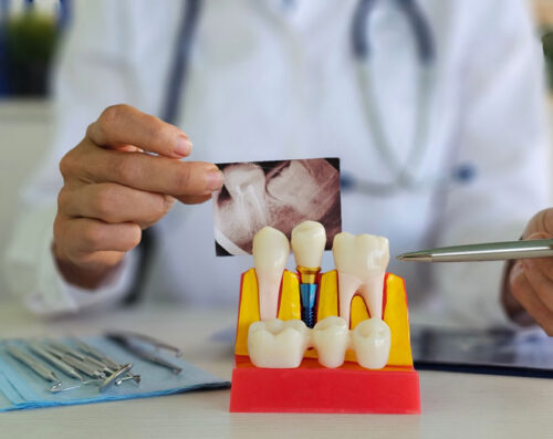 Dental professional examines tooth model and X-ray to assess patient condition and treatment options