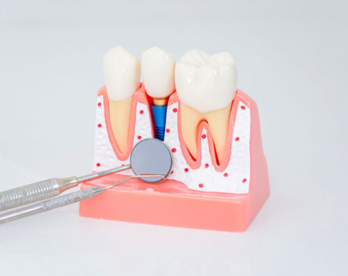 Dental implant, artificial tooth roots into jaw, root canal of dental treatment, gum disease, teeth model for dentist studying about dentistry