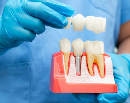 Dentist holding a dental implants model with blue gloves on in a dental office