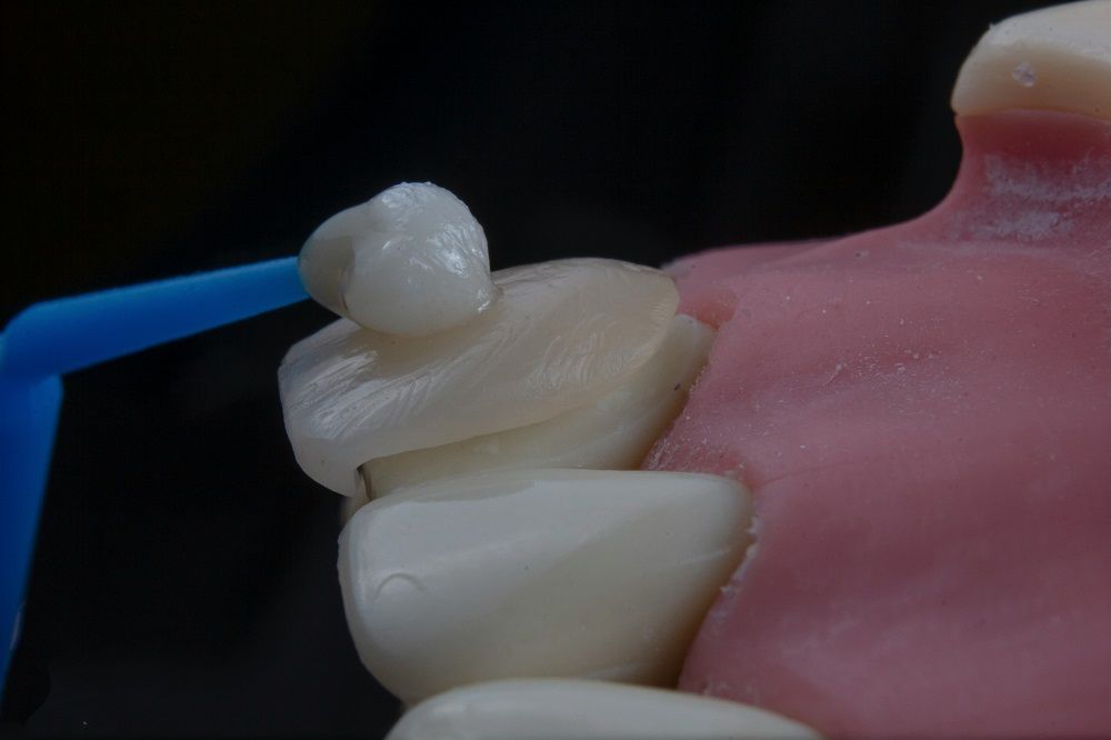 Composite Veneers VS Porcelain Veneers