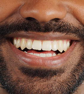 One-Day Smile Makeovers