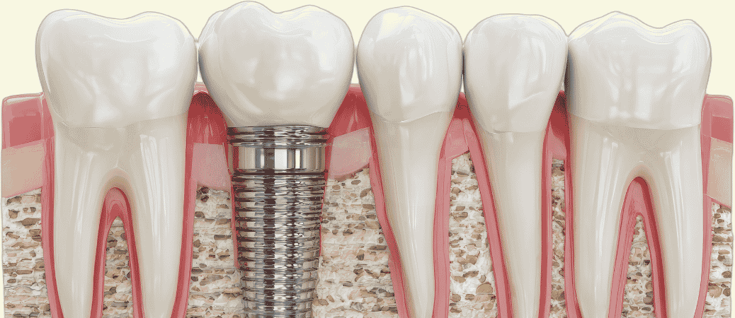 Do Implants Affect Surrounding Teeth