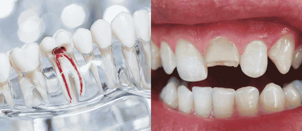 How Is a Cracked Tooth Treated: Crown, Root Canal, or Another Option?