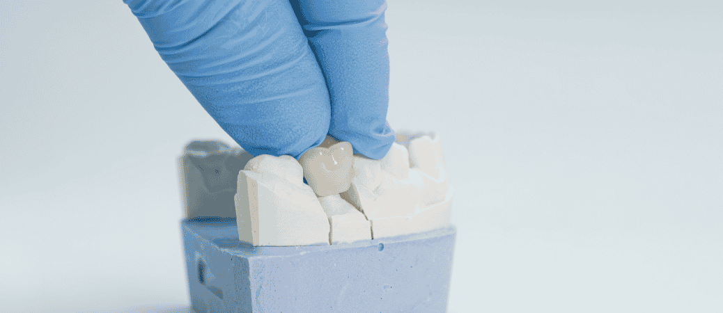 temporary fix for lost dental crown
