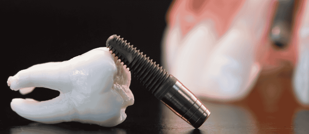 single tooth implant vs bridge